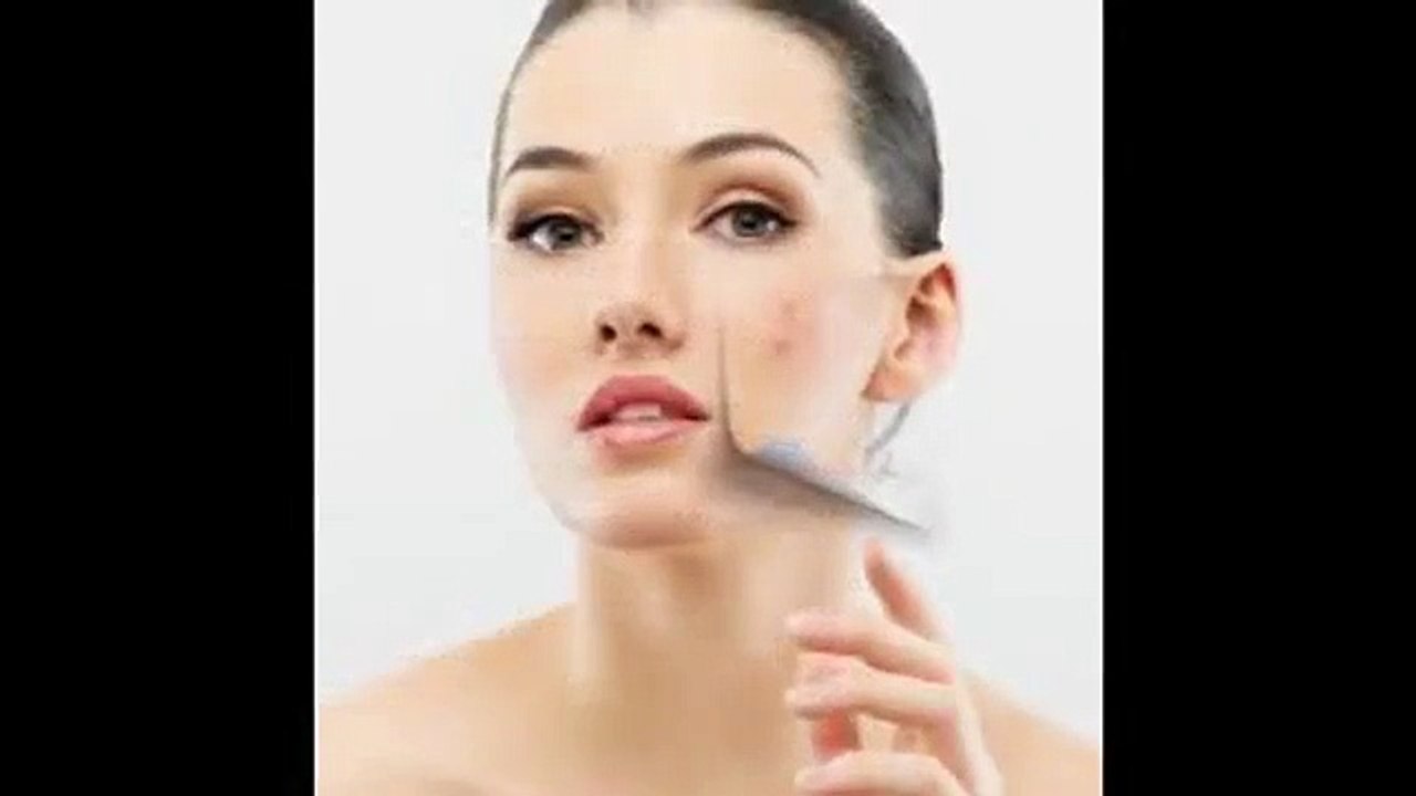 Know About Best Solution for Pimples - Solution for Acne