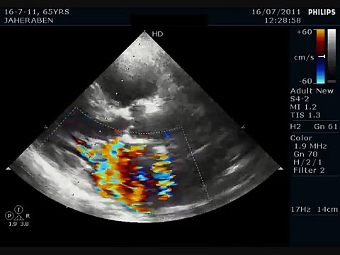 FLAIL MITRAL LEAFLET - ECHOCARDIOGRAPHY SERIES BY DR.ANKUR.K.CHAUDHARI