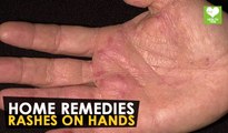 Rashes On Hands - Home Remedies | Health Tone Tips