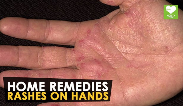 Rashes On Hands - Home Remedies | Health Tone Tips