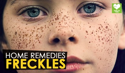 Download Video: Freckles - Home Remedies | Health Tone Tips