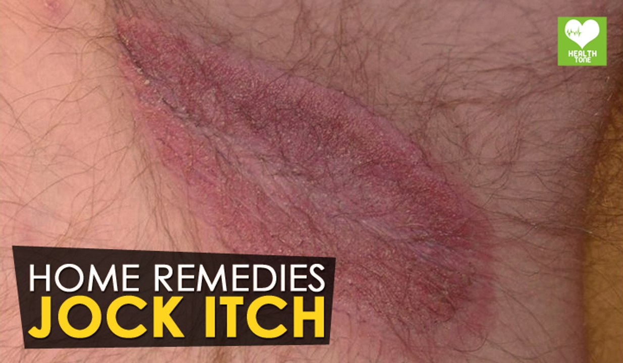 Jock Itch Treatment - Home Remedies | Health Tone Tips