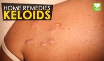 Keloids - Home Remedies | Health Tone Tips