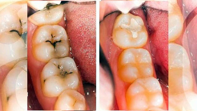 Dental Implants Key Biscayne