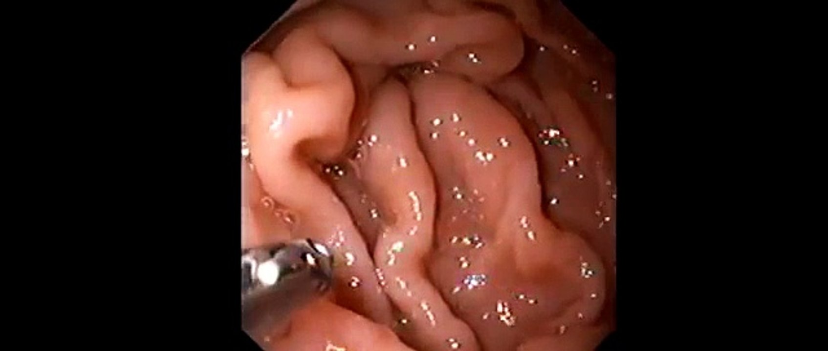 ulcere gastrique