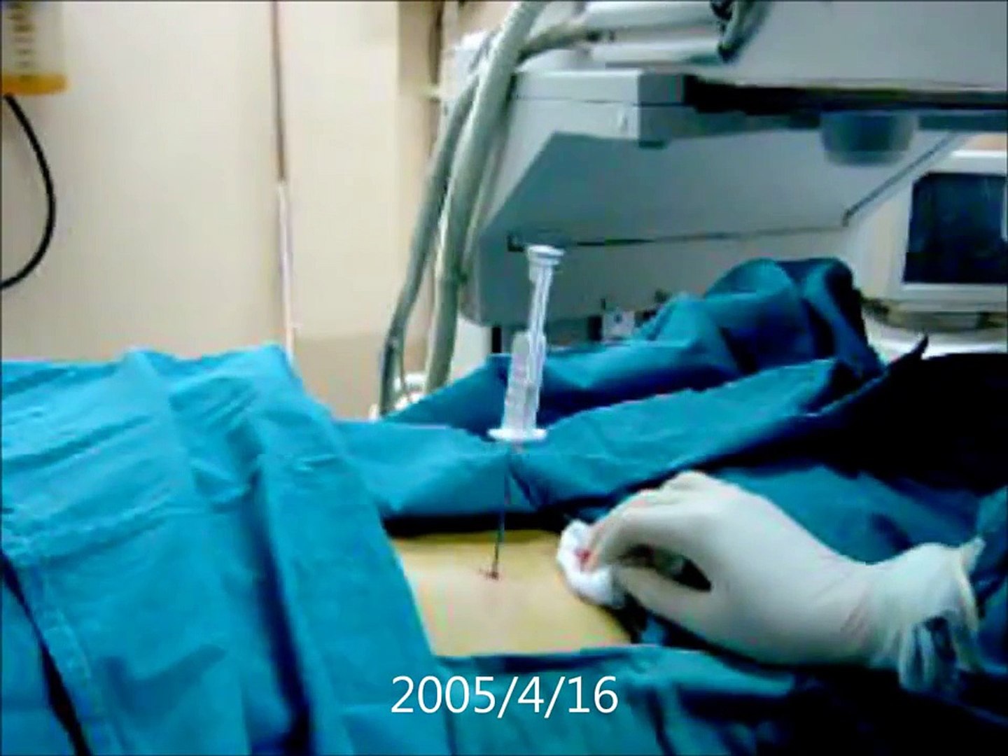 Renal Biopsy (I) - procedure and uses