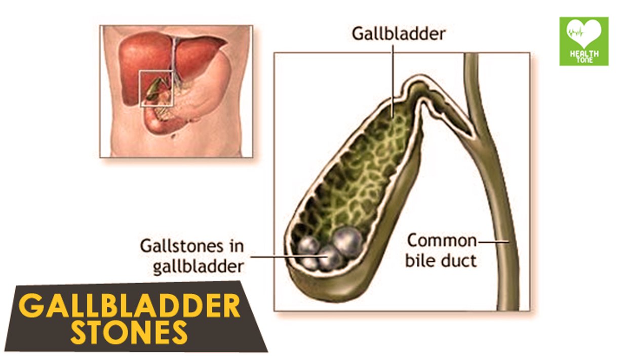 Gallbladder Stones - Natural Remedies | Health Tips | Education