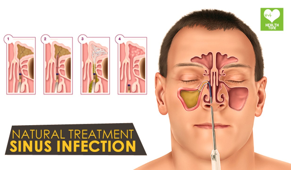Sinus Infection Natural Treatments | Health Tips | Education