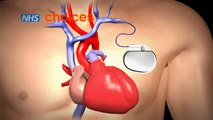 Pacemaker implantation animation