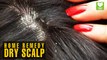Dry Scalp (सूखी सिर की त्वचा) - Home Remedies | Health Tips | Educational Video