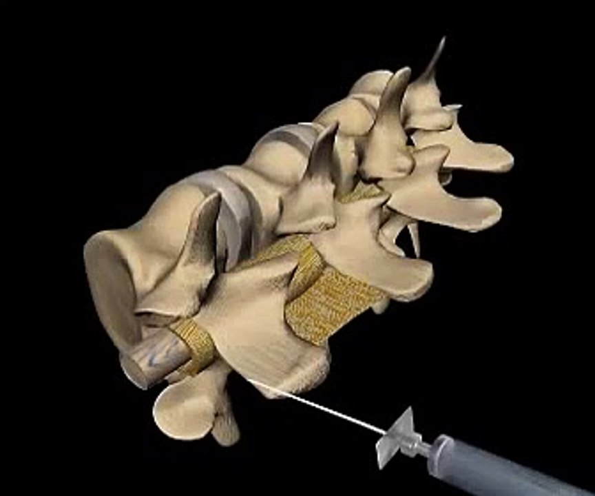 3D Animation of performing epidural anesthesia