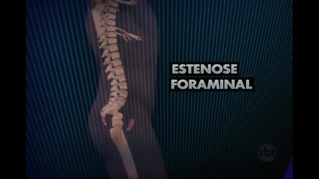 SP: Pelé passa por cirurgia na coluna e está internado