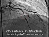 coronary artery angioplasty with stenting