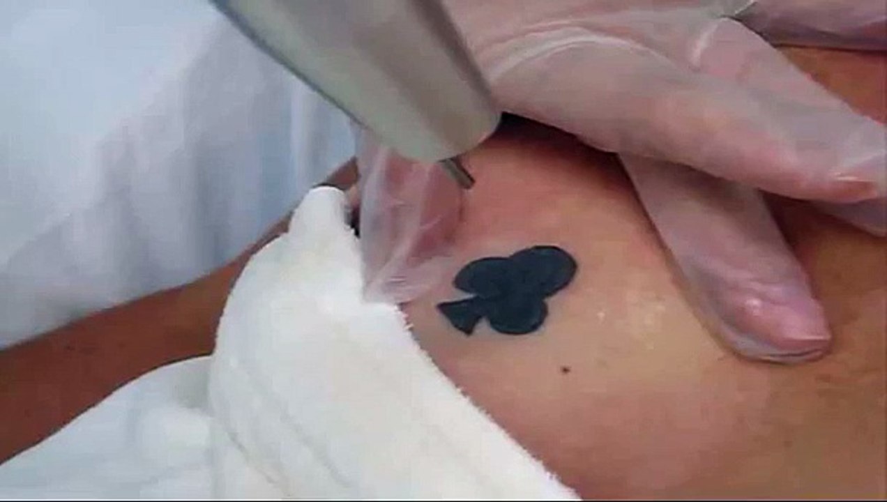 Laser Tattoo Removal - Breast No Numbing Cream