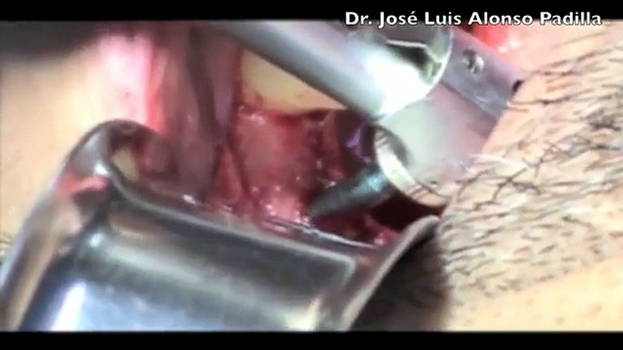 Implante Dental Bicon 36, colocación