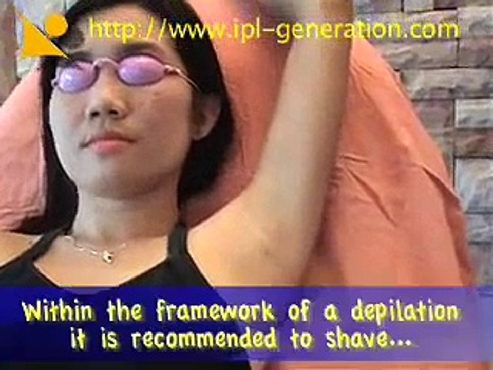 IPL, Hair removal