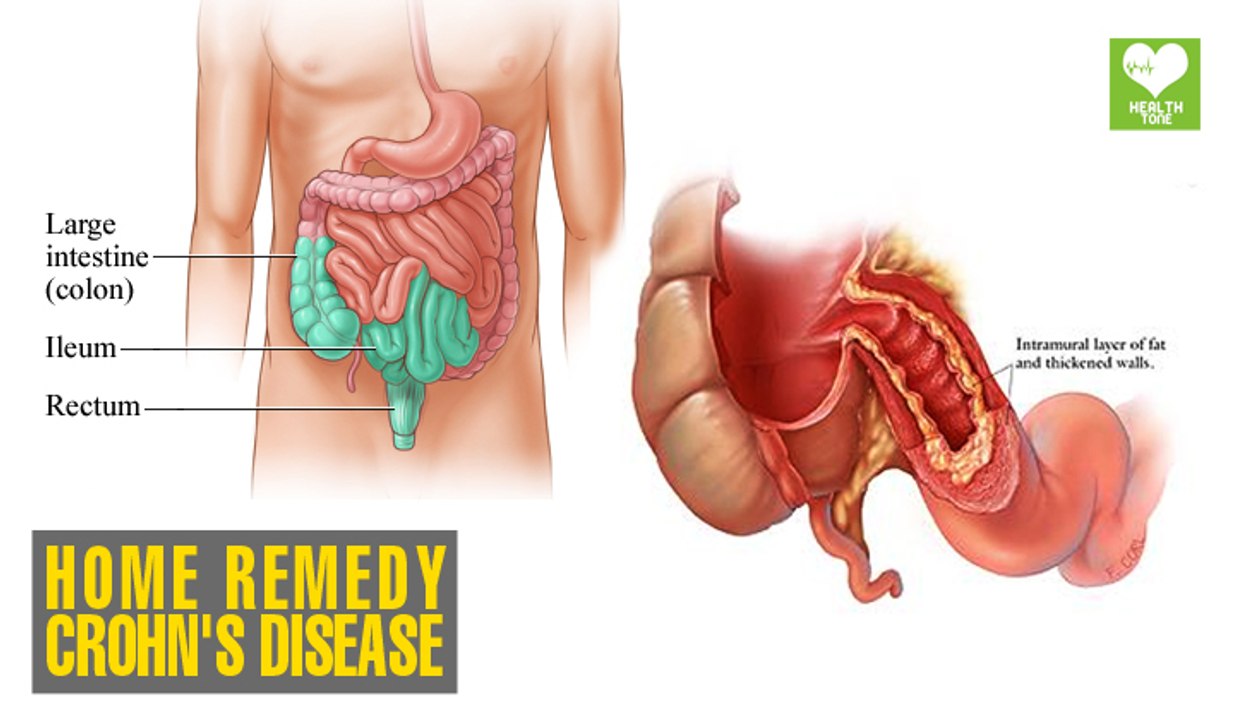 Natural Ways Stop Crohn's Disease | Health Tips | Educational Video