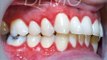 Teeth Cleaning, Brushing and Flossing-Dental