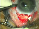 SICS Small Incision Cataract Surgery