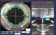 Stephen Slade MD Laser Cataract Surgery Docking