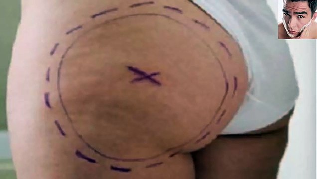 Cómo Eliminar Las Estrías Blancas En Los Glúteos