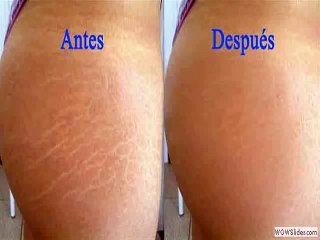 Cómo eliminar las estrías con limón