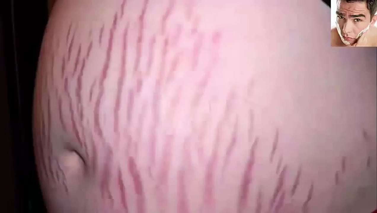 Como quitar las estrias naturalmente con remedios caseros