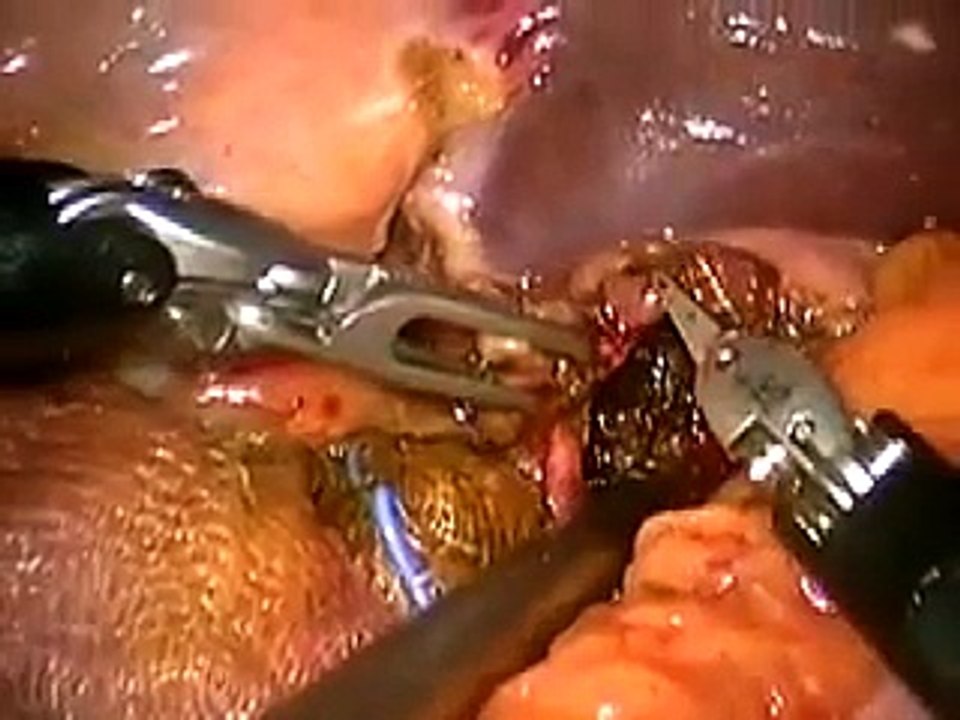 Robotic Surgery of Biliary tract (Robotical Surgery: Difficult Biliary gallstones) B. Orlandi MD