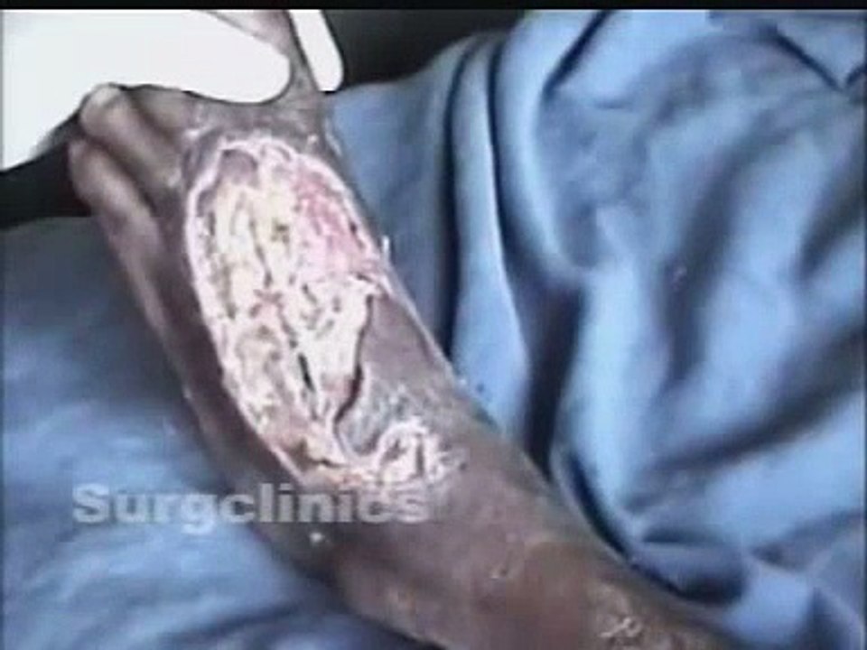 10. Examination of an Ulcer - SurgClinics - Dr. Dasari