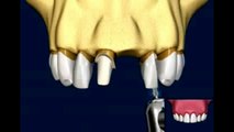 Implantes Dentales Vs Puente. Dr Lombardi. Dental implants vs. bridge