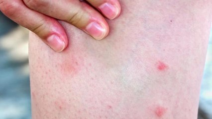 5 Reasons mosquitoes 'like' you over others