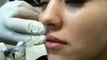 Makeover Competition, lip augmentation and dermal fillers Sydney face rejuvenation clinic