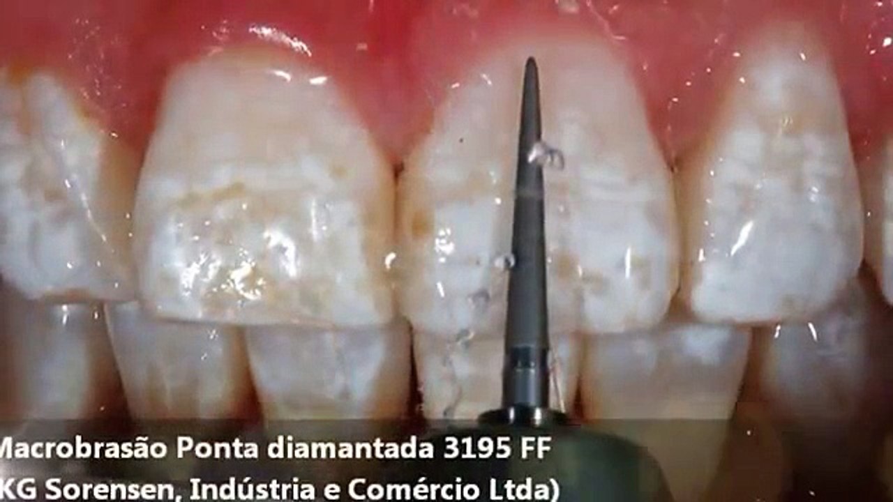 Opalustre Enamel Microabrasion Clinical video by Dr. Sundfled et al