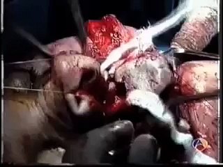 Dr. Beltrán entrevista Dr. Furelos acerca de la cirugía del cáncer oral y maxilofacial