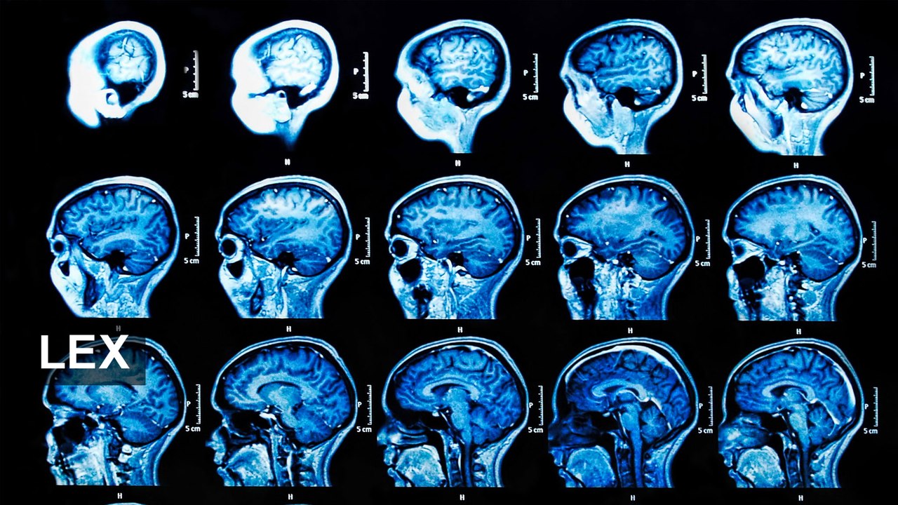 Eli Lilly Alzheimer’s hopes overdone?