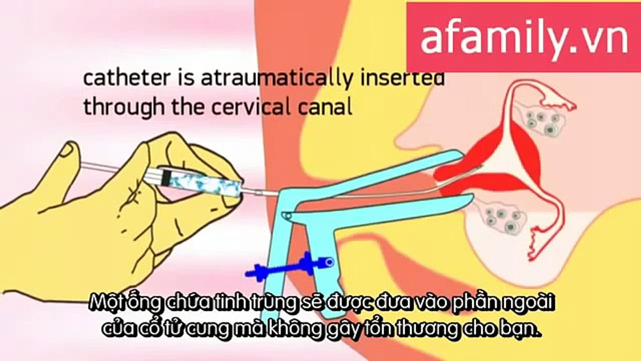 Cận cảnh bơm tinh trùng vào buồng tử cung