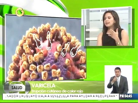 Especialista: Embarazada puede transmitir enfermedad de varicela al feto