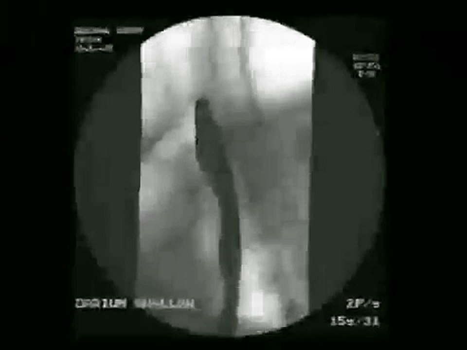 Barium Swallow