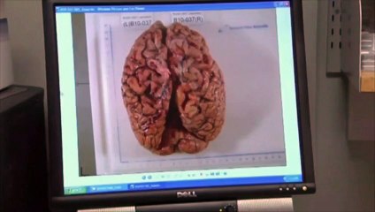 Un espoir pour le traitement précoce d'Alzheimer