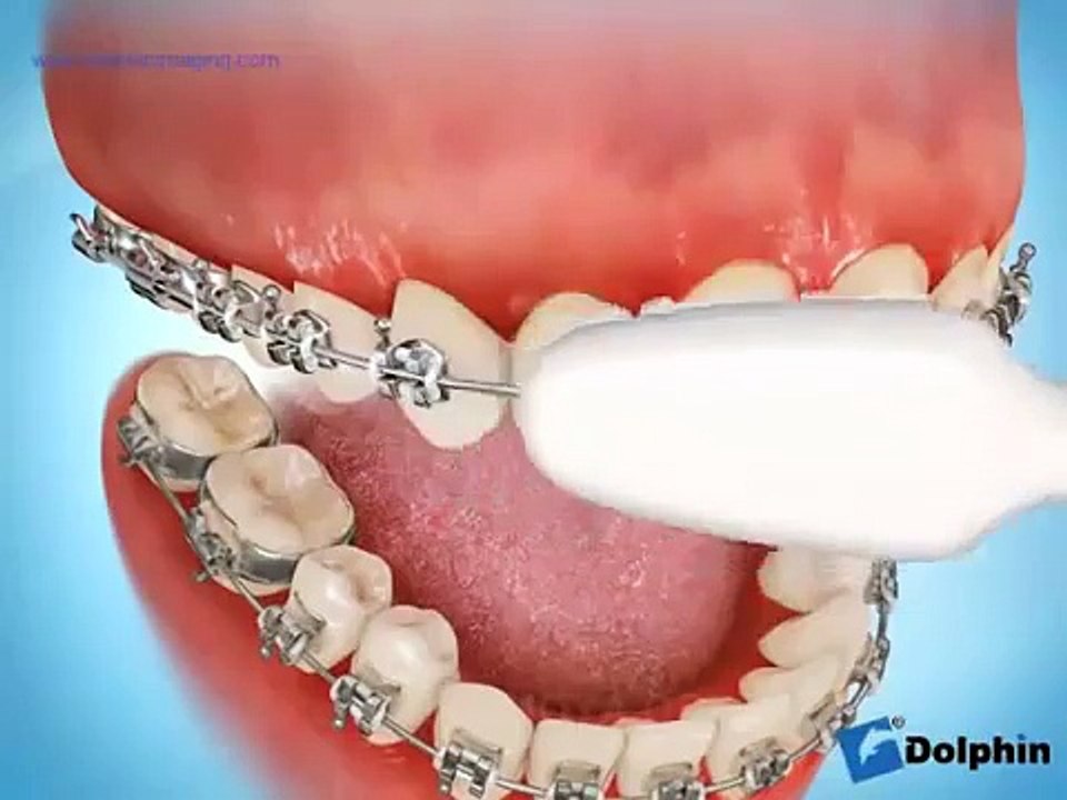Técnica de Cepillado con encías inflamadas