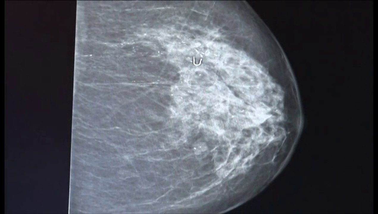 La mutación "BRaCA" que lleva al cáncer de mama y ovario