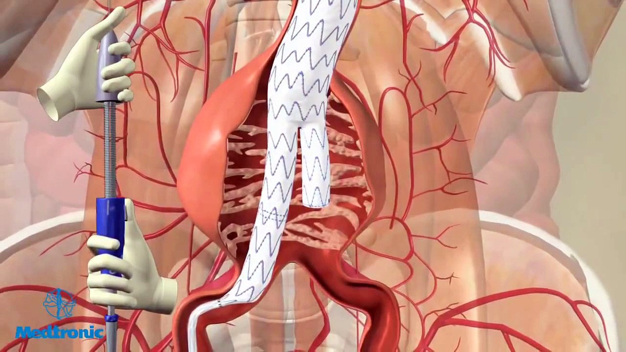 Operatie aneurysma van de buikslagader (EVAR-procedure)