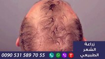تكلفة زراعة الشعر في تركيا افضل مشفئ للتواصل 00905315897055