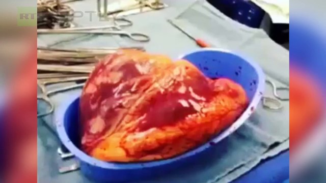 Un corazón bajo los efectos de la cocaína late media hora después de ser extraído