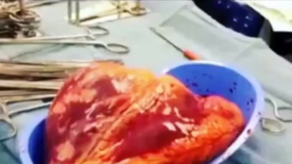 Çıkarılan kalbi 25 dakika boyunca attı!