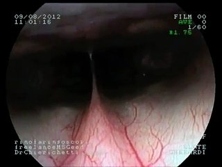vegetal foreign body nostril extraction