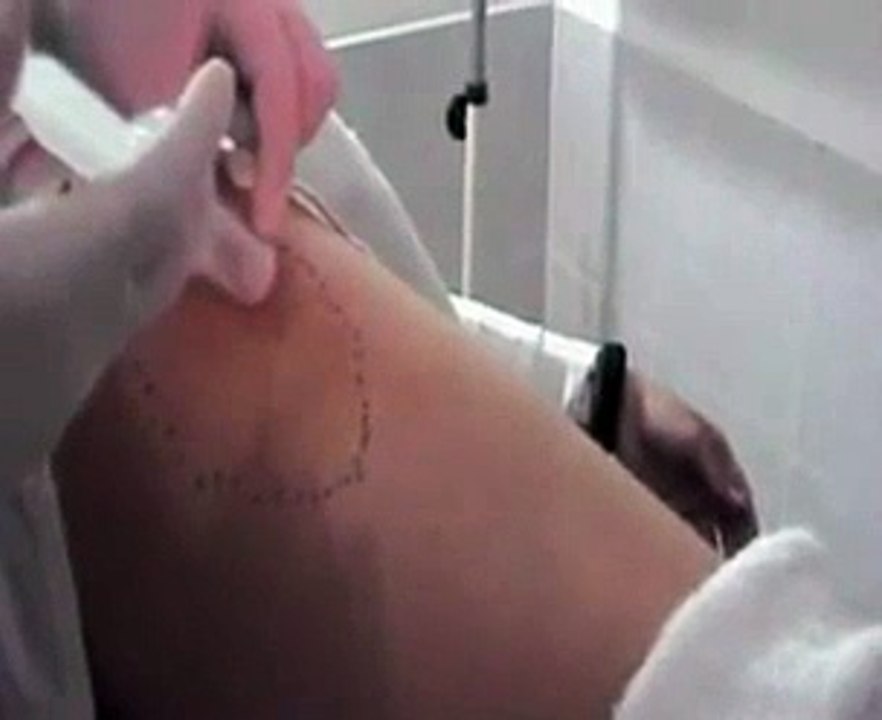 Tratamiento de celulitis y estrias con ozonoterapia