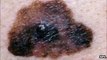 Skin cancer 'able to fight off body's immune system'