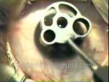 WHAT IS LASIK EYE SURGERY? VIEW LASIK VIDEO NOW!!!