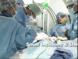 Minimally Invasive Aneurysm Repair at Cooper University Hospital